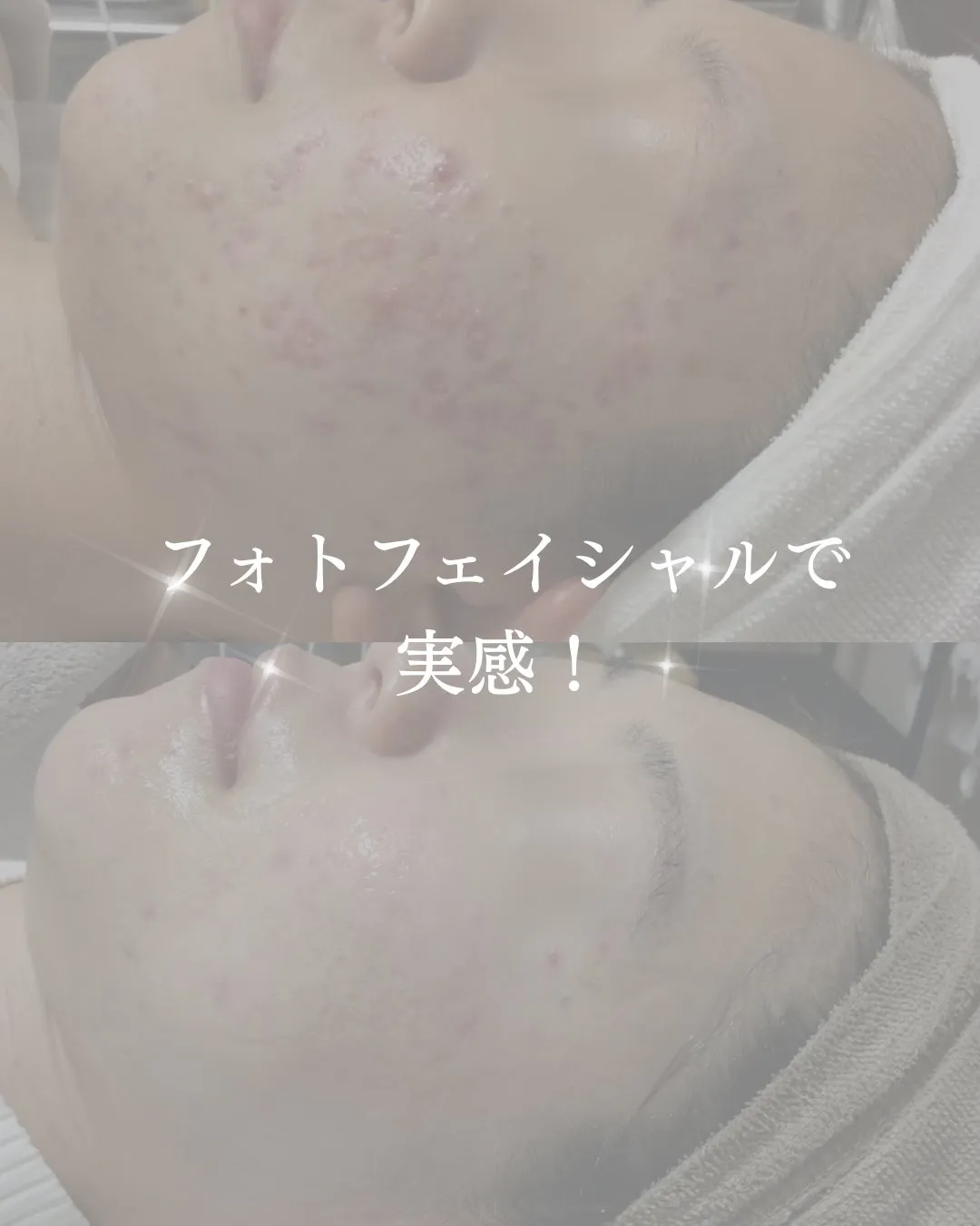 ニキビでお悩みの方必見👀!